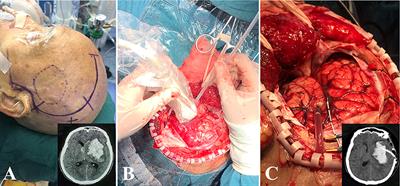 Decompressive Hemicraniectomy Associated With Ultrasound-Guided Minimally Invasive Puncture and Drainage Has Better Feasibility Than the Traditional Hematoma Evacuation for Deteriorating Spontaneous Intracranial Hemorrhage in the Basal Ganglia Region: A Retrospective Observational Cohort Study